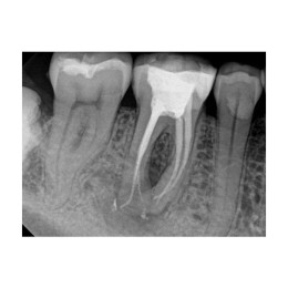 Kodak RVG 6200 (США)