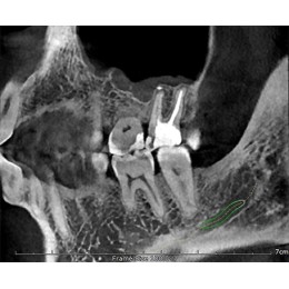 GENORAY Papaya 3D томограф 16x8 (Ю.Корея)