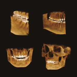 GENORAY Papaya 3D томограф 16x8 (Ю.Корея)