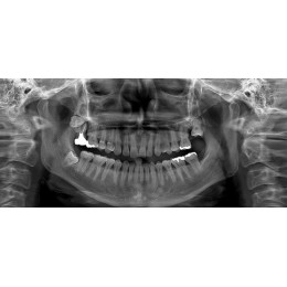 Ray RAYSCAN Alpha P – ортопантомограф