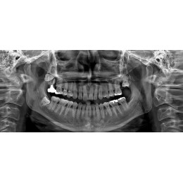 Ray RAYSCAN Alpha P – ортопантомограф