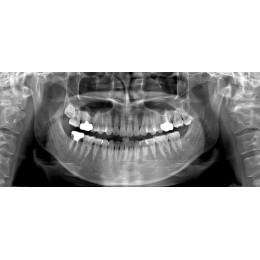 Ray RAYSCAN Alpha P – ортопантомограф