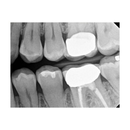 Kodak RVG 6200 (США)