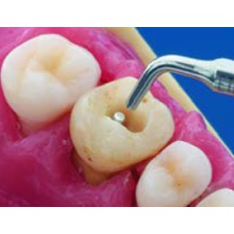 ETPR Насадка к скалеру F88019 - Satelec Acteon Group (Франция)