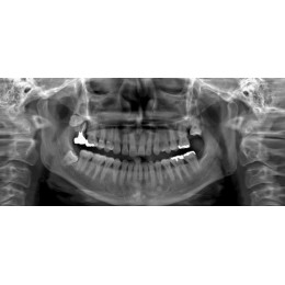Ray RAYSCAN Alpha P – ортопантомограф