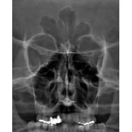 Ray RAYSCAN Alpha P – ортопантомограф