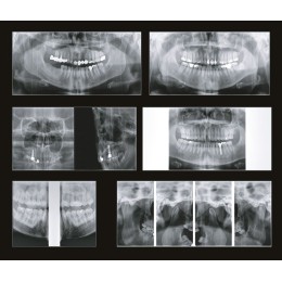 GENORAY Papaya 3D томограф 16x8 (Ю.Корея)